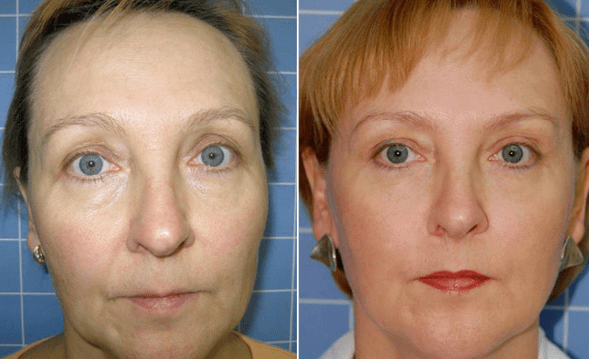 Before and after recovery program