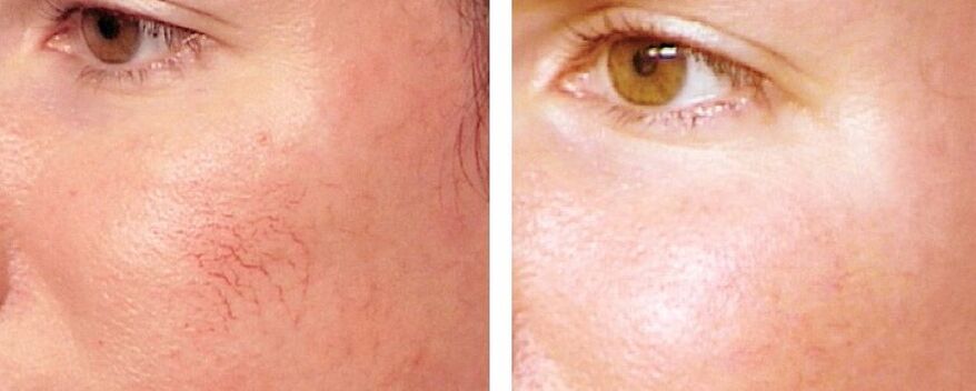 Remove rosacea