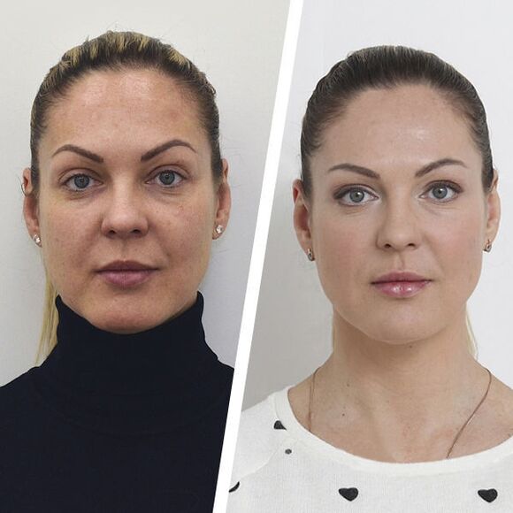 Surgery-free facial rejuvenation before and after