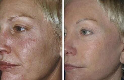 Fractional laser skin rejuvenation before and after photos