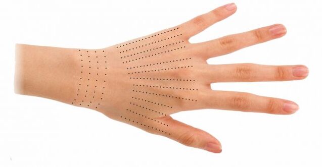Hand injection site during bioregeneration
