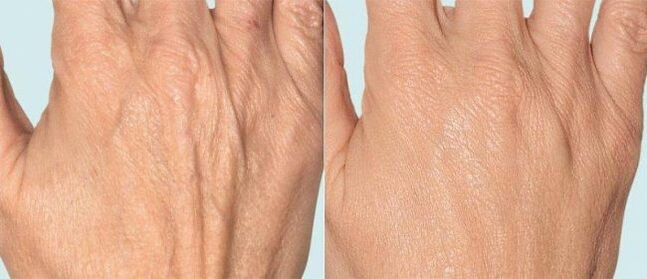 Hand skin before and after segmental treatment