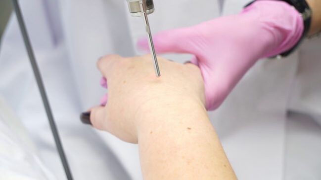 Laser hand rejuvenation