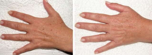 The effect of removing pigment spots on hands
