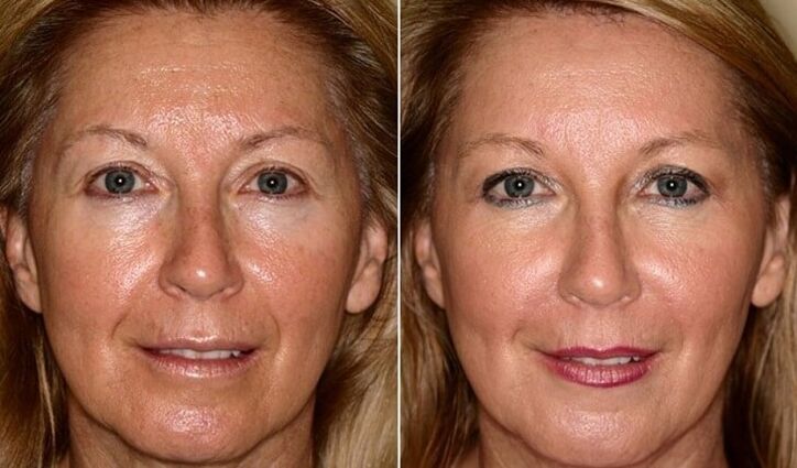 Before and after facial rejuvenation at home