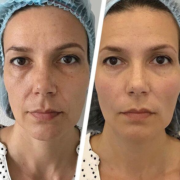 Facial photos before and after laser rejuvenation